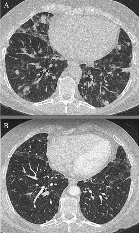 Granulomatous Lymphocytic Interstitial Lung Disease Captions Pages