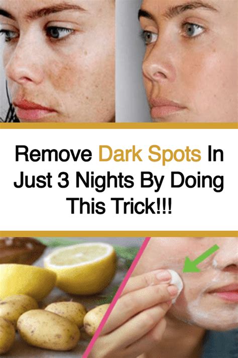 Remove Dark Spots In Just 3 Nights By Doing This Trick Brown Spots On