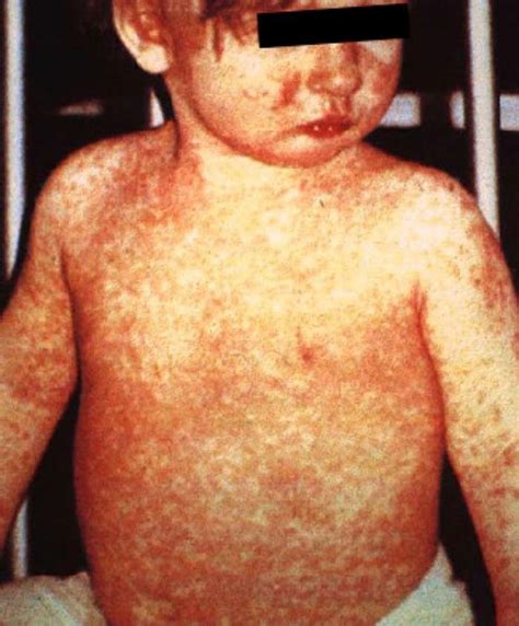 Photos Of Measles And People With Measles Cdc