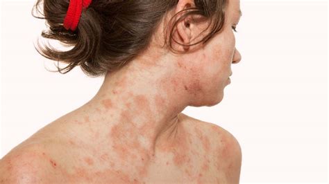 Scabies Or Eczema Here Is How To Know
