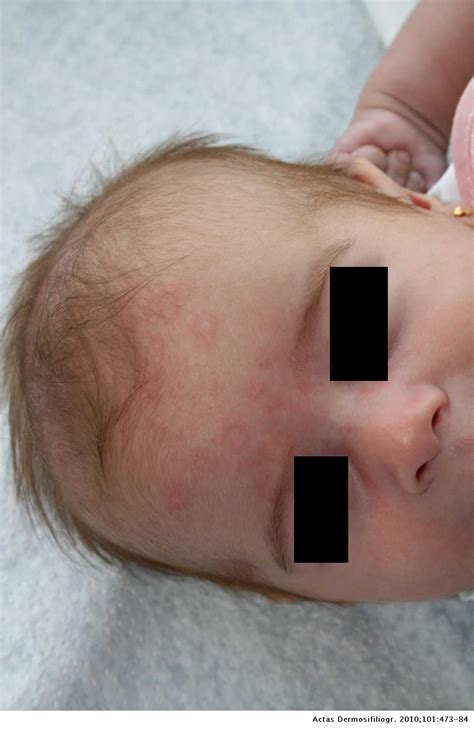 Eritemas Anulares En La Infancia Actas Dermo Sifiliográficas