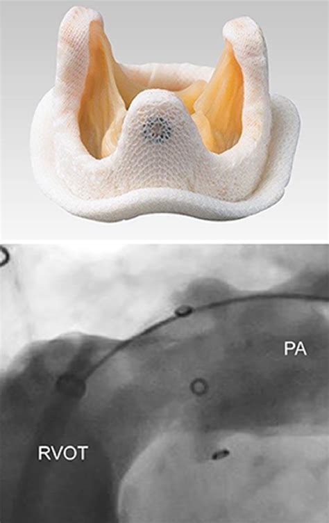 Durability Of Pulmonary Valve Replacement With Large Diameter Stented