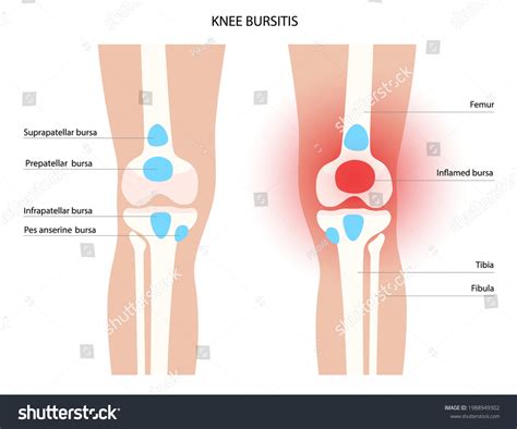 Knee Bursitis Inflammation Inflamed Bursa Human Stock Vector Royalty