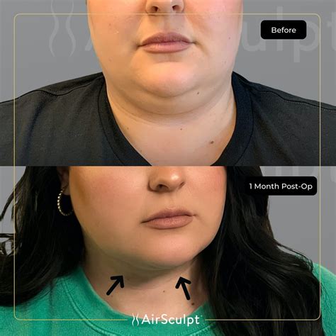 See What Double Chin Removal With Airsculpt® Achieved In Just One Month