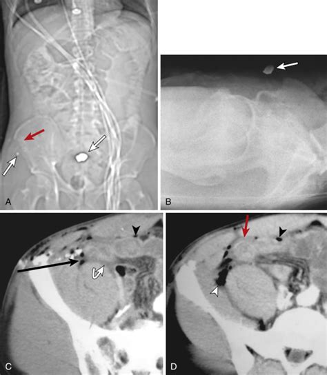 Imaging Of Penetrating Trauma To The Torso And Chest Radiology Key