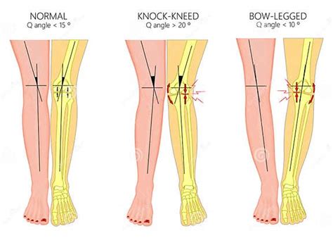 Shapes Of The Legsnormal And Curved Legsknock Kneesbowed Leg Stock