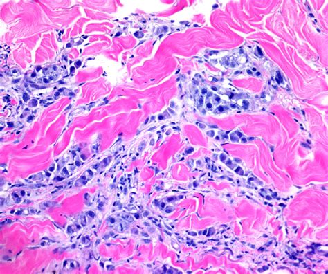 Pathology Outlines Inflammatory Carcinoma
