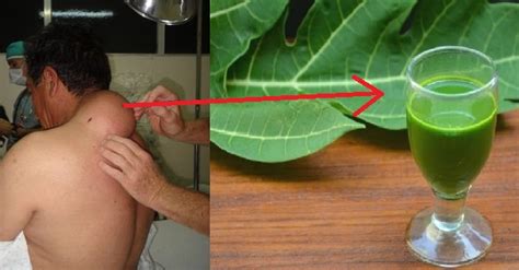 AJAIB, Dalam Masa Yang Singkat Tumor Hancur Sampai Keakar- Akarnya