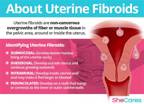 Pathophysiology Of Uterine Fibroids