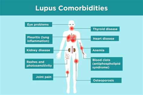 Lupus Complications What Lupus Patients Need To Know Lupus Nephritis