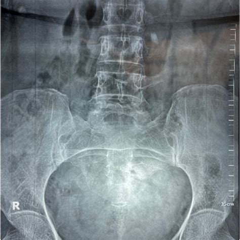 The Preoperative X Ray Kidney Ureter Bladder Kub Shows The