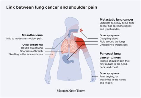 Lung Cancer And Shoulder Pain What S The Link