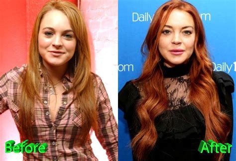 Lindsay Lohan Before And After Surgery Procedure Celebrity Plastic