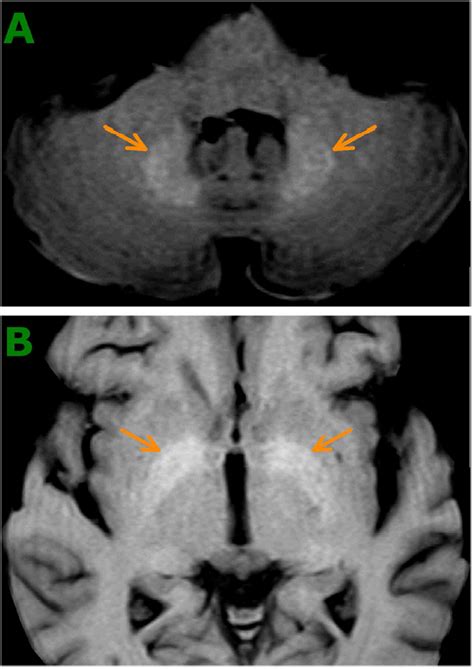 High Signal Intensity In Dentate Nucleus And Globus Pallidus On