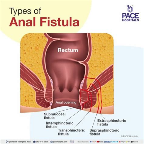 Anal Fistula Symptoms Causes Types Complications 40 Off