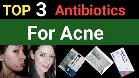 Best Antibiotic For Acne Oral Antibiotics For Acne Best Medicine