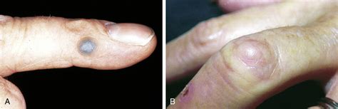 Granulomatous Diseases Of The Skin Plastic Surgery Key