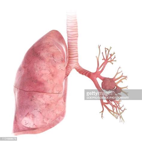 Bronchial Cancer Photos And Premium High Res Pictures Getty Images