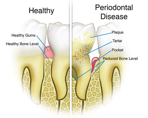 What Are Periodontal Gum Pockets