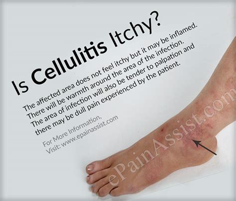Is Cellulitis Itchy