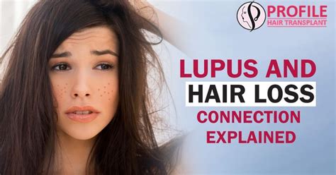 Lupus And Hair Loss Connection Explained Hairtransplant