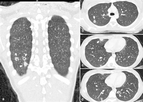 Contrast Enhanced Ct Scan Of The Thorax Showing Multiple Lung Abscesses