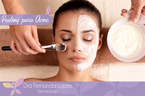 Dra Fernanda Lopes Dermatologia Blog Peeling Para Acne