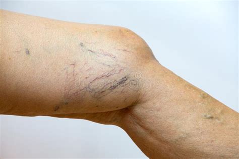 Varicose Veins On A Leg In Senior Women In White Background Close Up