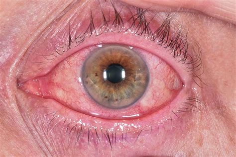 Allergic Conjunctivitis Photograph By Dr P Marazziscience Photo Library