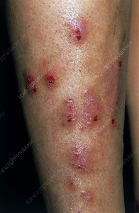 Rash On Legs Stock Image M2000146 Science Photo Library