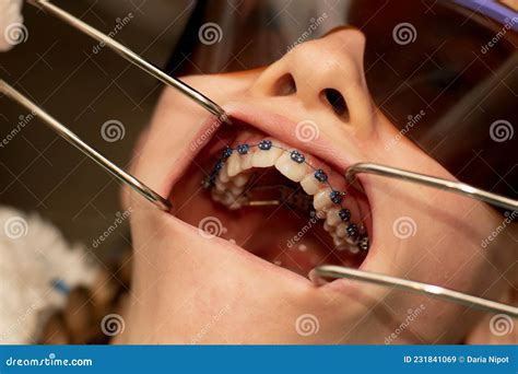 Mouth Opened With Dental Retractors To Show Metal Braces And Teeth Palatal Expander Orthodontic