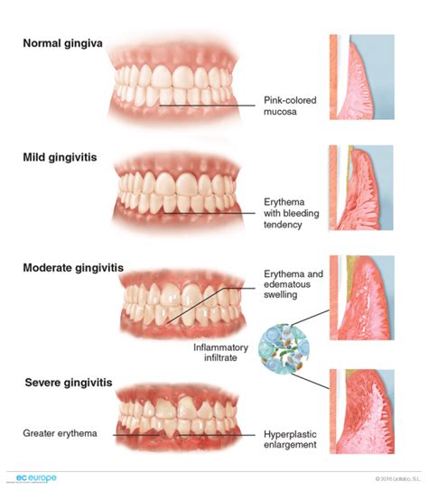 Severity Degrees Of Gingivitis Dentistry Dental Assistant Dental Facts