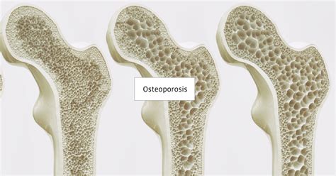 Sport is very important and beneficial for our health. Osteoporosis | Cause | Symptoms | Diagnosis | Treatment ...