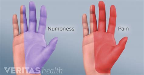 Tes ini membantu dokter mengetahui apakah kebas dan sakit tangan kanan memiliki gout atau sesuatu yang lain dengan gejala serupa: Cara Menghilangkan Rasa Kebas Di Jari Tangan ...