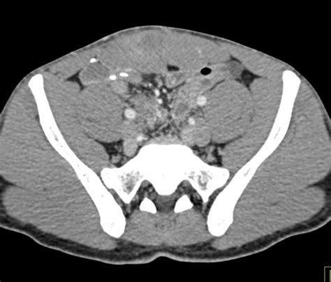 Desmoid Tumor In Rectus Muscle In Patient With Fap Familial Polyposis