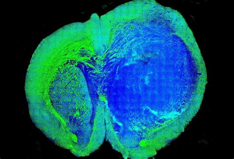 Tool Sees Invisible Tumors In Brain Tissue Futurity