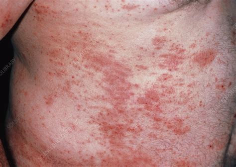 Acute Eczema On The Torso Of An Adult Male Patient Stock Image M150