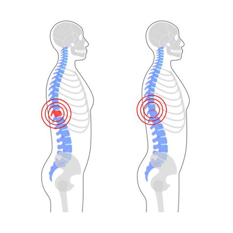 Cervical Fracture Human Spine Vertebrae Damage Outline Diagram Labeled