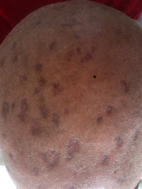What Are These Spots On The Skull Skin Of A Diabetic Patient