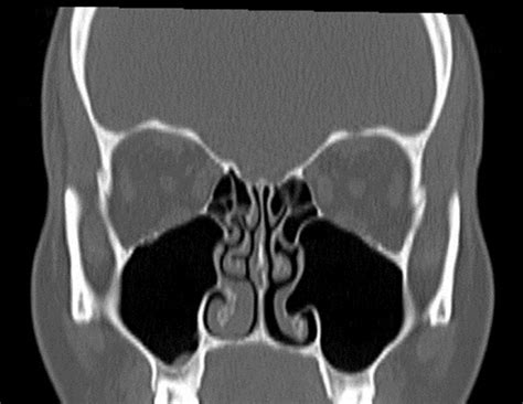 Common Cavity Of Pneumatized Inferior Turbinate And Maxillary Sinus A