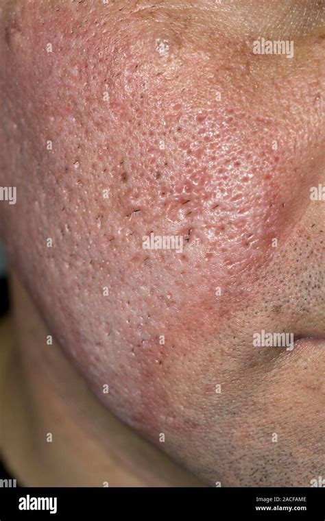 Acne Scar Treatment Cheeks Of A Man With Acne Scarring After