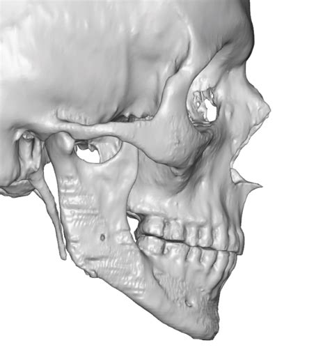 Standard Facial Implant Bone Imprinting 3d Ct Scan Side View Dr Barry