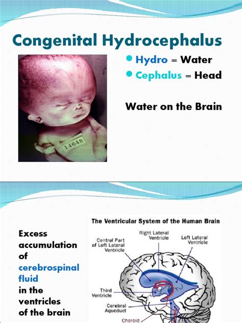 Congenital Hydrocephalus