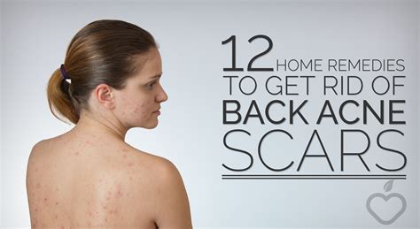 What Gets Rid Of Acne Scars Fast