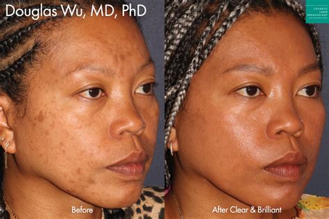 African American Skin Treatments San Diego Ca Clderm