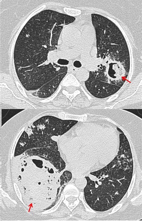 Axial Plain Multidetector Ct Sections Of Chest In Lung Window Showing