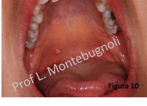 Manifestazioni Orali Da Papillomavirus Hpv Patologia Orale