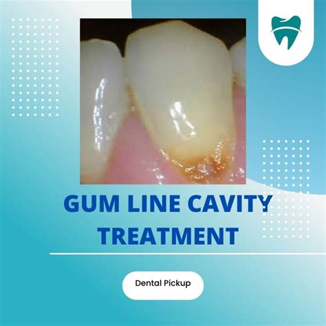 Gum Line Cavity Treatment Dental Pickup