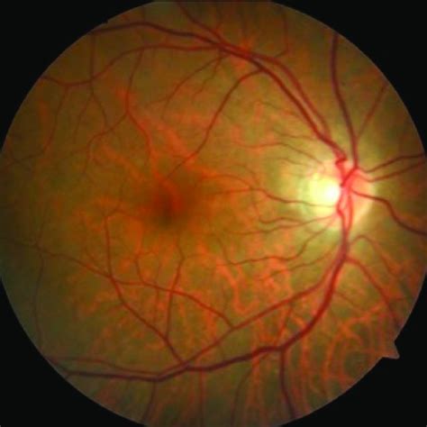 Fundus Image Of The Patient At 2 Months Retinal Pallor Was Improved