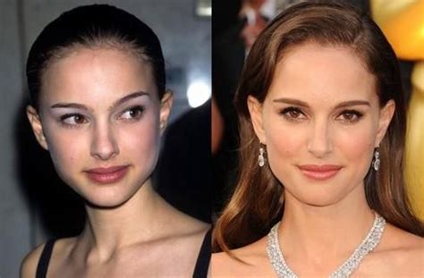 Natalie Portman Plastic Surgery Before And After Before Celebrity Plastic Surgery Plastic
